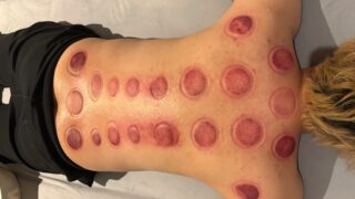 実際に体験！吸い玉（カッピング）の効果に驚きました